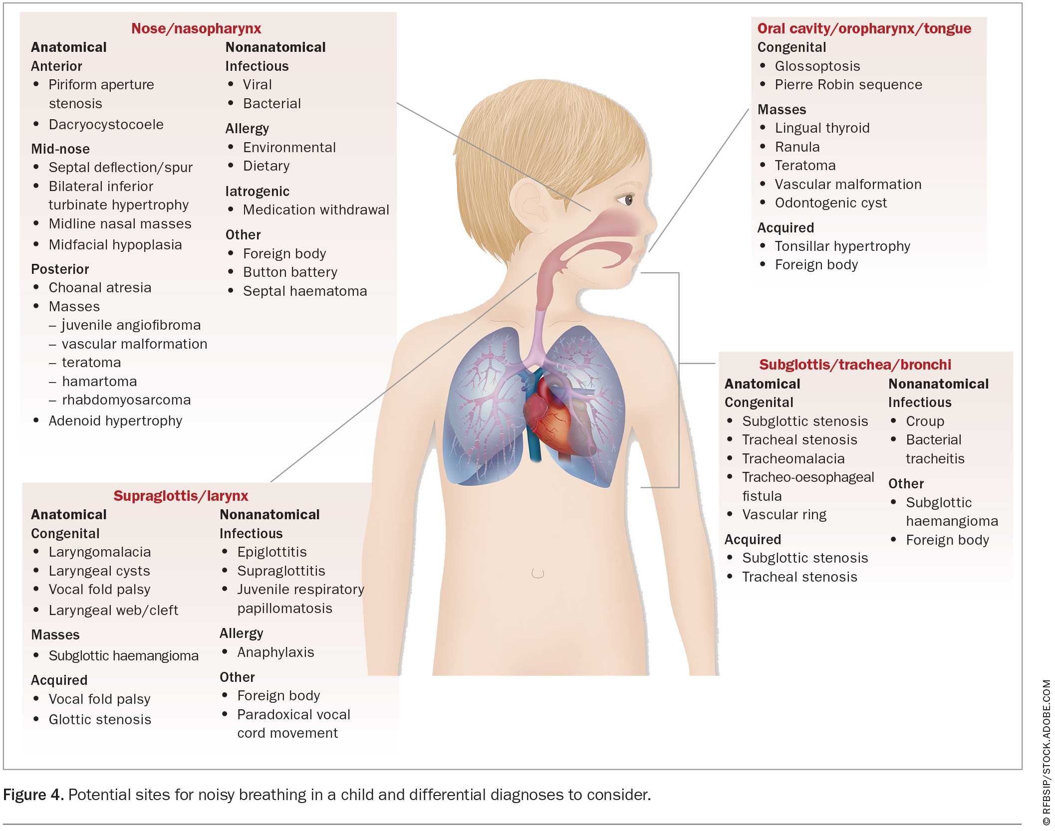 Noisy breathing in children. When to be concerned Medicine Today